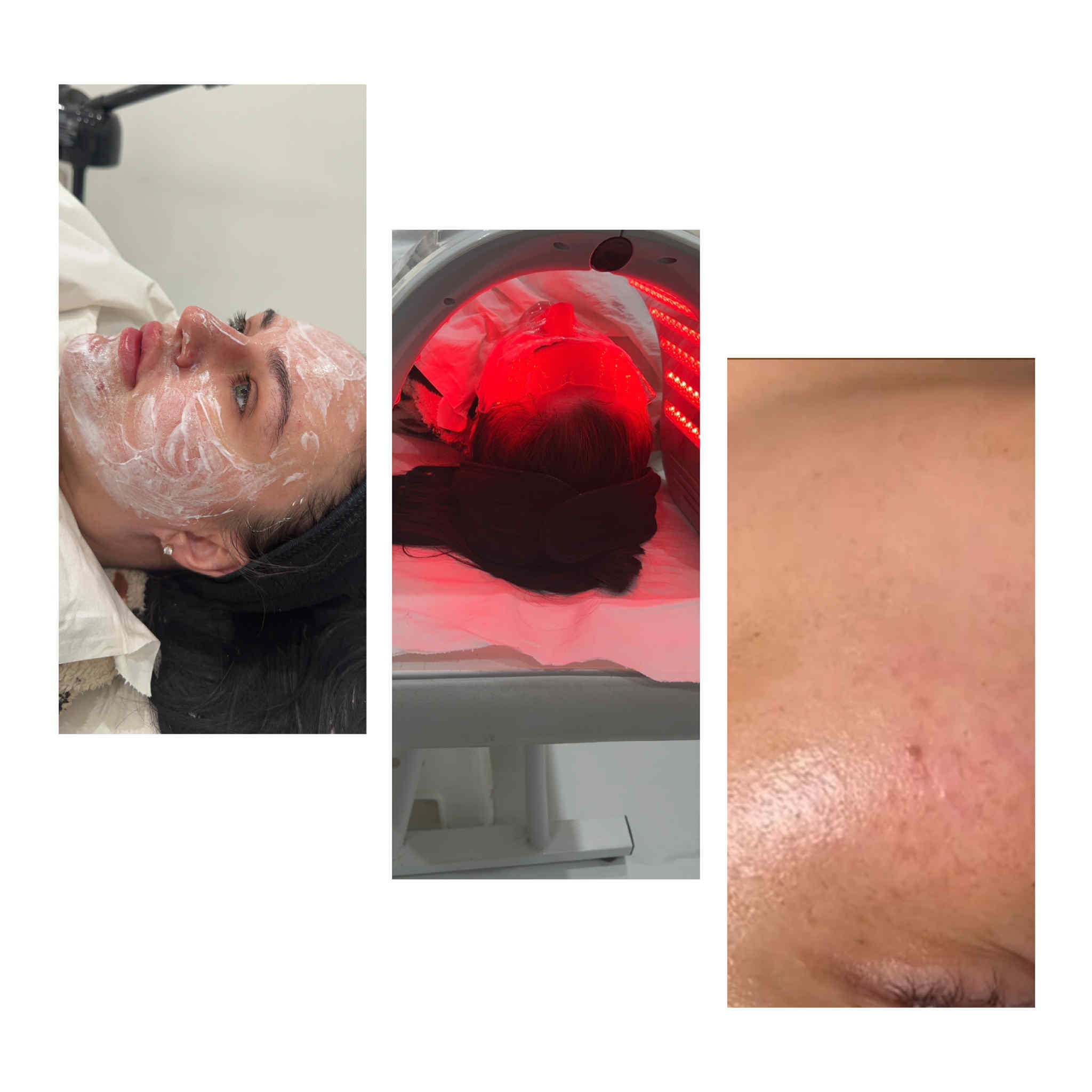 Hydrafacial Treatment for hydration and glow